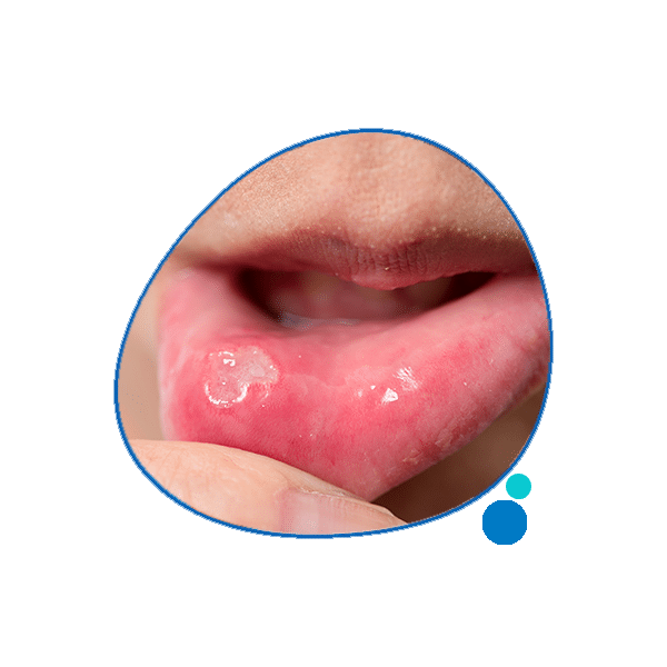 Ulcere Orali